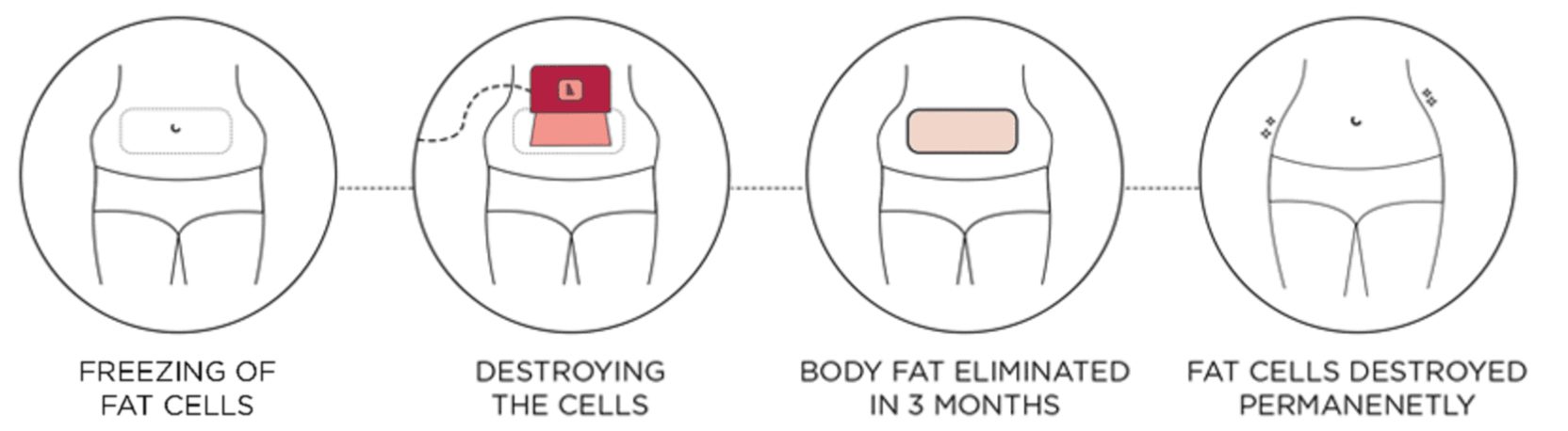 Coolsculpting Treatment Process